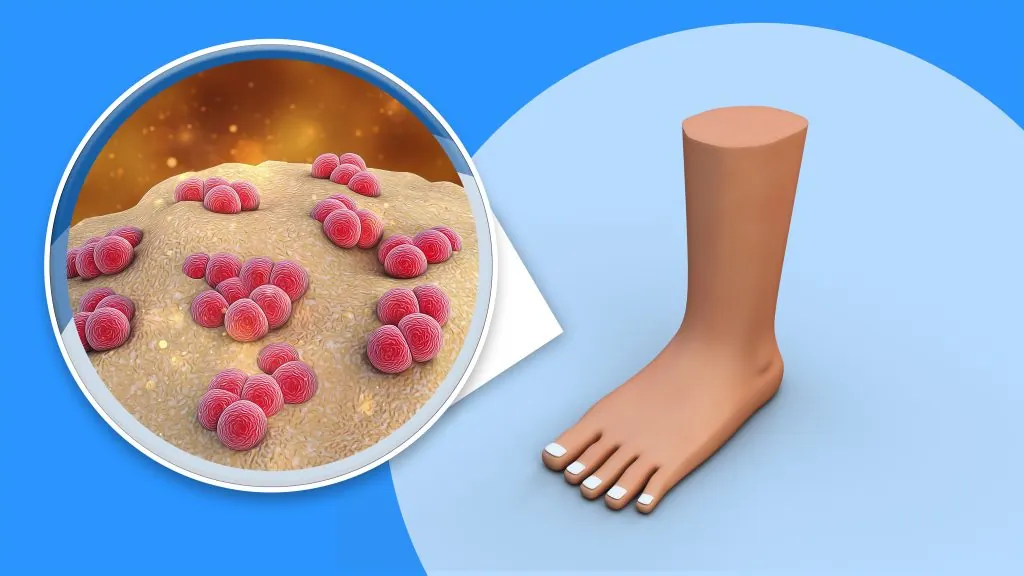 Fungos na Praia e Piscina: Como Prevenir Micoses